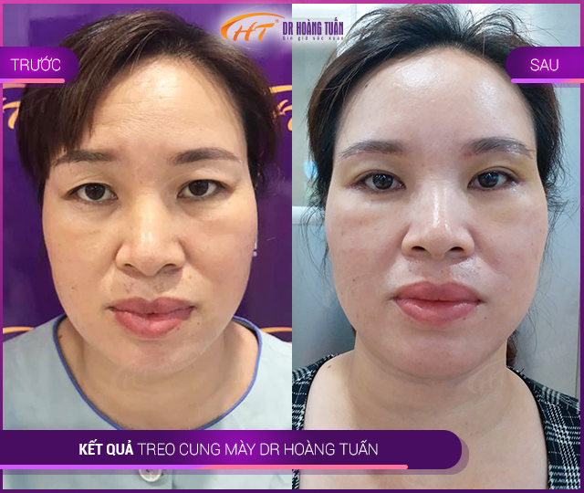 Kết quả nâng cung chân mày tại Thẩm mỹ Hoàng Tuấn